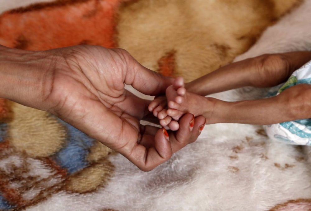 174 millones de personas con "alto riesgo" de morir por desnutrición