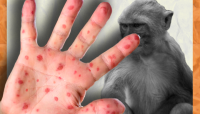 Viceministra cree que paciente cero de viruela de mono retornó a Canadá